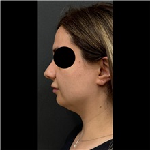 Liposuction Before Photo by Cem Berkay SINACI, MD; Istanbul, M - Case 51065