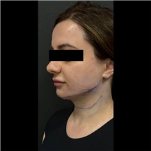 Liposuction After Photo by Cem Berkay SINACI, MD; Istanbul, M - Case 51065