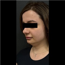 Liposuction Before Photo by Cem Berkay SINACI, MD; Istanbul, M - Case 51065