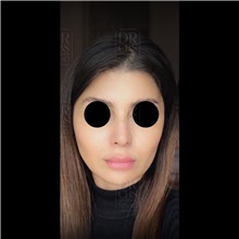 Cheek Reduction After Photo by Cem Berkay SINACI, MD; Istanbul, M - Case 51057