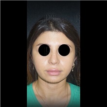 Cheek Reduction Before Photo by Cem Berkay SINACI, MD; Istanbul, M - Case 51057