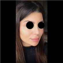 Cheek Reduction After Photo by Cem Berkay SINACI, MD; Istanbul, M - Case 51057