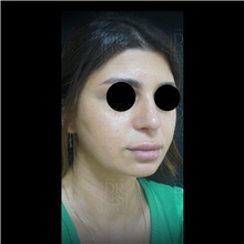 Cheek Reduction Before Photo by Cem Berkay SINACI, MD; Istanbul, M - Case 51057