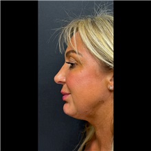 Chin Augmentation After Photo by Cem Berkay SINACI, MD; Istanbul, M - Case 51060