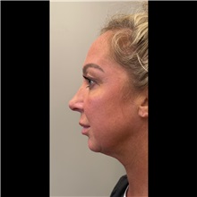 Chin Augmentation Before Photo by Cem Berkay SINACI, MD; Istanbul, M - Case 51060