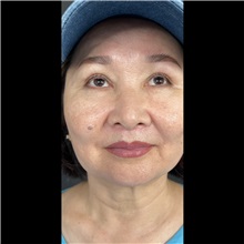 Lip Augmentation/Enhancement After Photo by Cem Berkay SINACI, MD; Istanbul, M - Case 51066