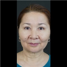 Lip Augmentation/Enhancement Before Photo by Cem Berkay SINACI, MD; Istanbul, M - Case 51066