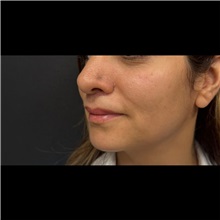 Lip Augmentation/Enhancement After Photo by Cem Berkay SINACI, MD; Istanbul, M - Case 51069