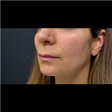 Lip Augmentation/Enhancement Before Photo by Cem Berkay SINACI, MD; Istanbul, M - Case 51069