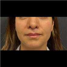 Lip Augmentation/Enhancement After Photo by Cem Berkay SINACI, MD; Istanbul, M - Case 51069