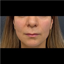 Lip Augmentation/Enhancement Before Photo by Cem Berkay SINACI, MD; Istanbul, M - Case 51069
