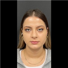 Cheek Reduction After Photo by Cem Berkay SINACI, MD; Istanbul, M - Case 51056