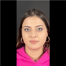 Cheek Reduction Before Photo by Cem Berkay SINACI, MD; Istanbul, M - Case 51056