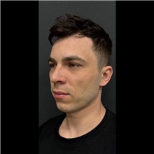 Chin Augmentation Before Photo by Cem Berkay SINACI, MD; Istanbul, M - Case 51059