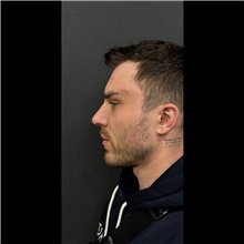 Chin Augmentation After Photo by Cem Berkay SINACI, MD; Istanbul, M - Case 51059
