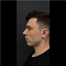 Chin Augmentation Before Photo by Cem Berkay SINACI, MD; Istanbul, M - Case 51059