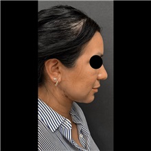 Liposuction After Photo by Cem Berkay SINACI, MD; Istanbul, M - Case 51064