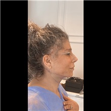 Liposuction After Photo by Cem Berkay SINACI, MD; Istanbul, M - Case 51063