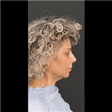 Liposuction Before Photo by Cem Berkay SINACI, MD; Istanbul, M - Case 51063