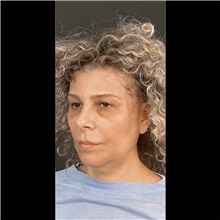 Liposuction Before Photo by Cem Berkay SINACI, MD; Istanbul, M - Case 51063
