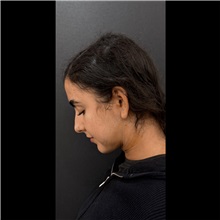 Liposuction After Photo by Cem Berkay SINACI, MD; Istanbul, M - Case 51061