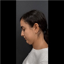 Liposuction Before Photo by Cem Berkay SINACI, MD; Istanbul, M - Case 51061