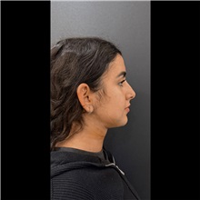 Liposuction After Photo by Cem Berkay SINACI, MD; Istanbul, M - Case 51061
