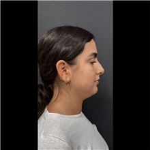 Liposuction Before Photo by Cem Berkay SINACI, MD; Istanbul, M - Case 51061
