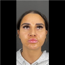 Lip Augmentation/Enhancement After Photo by Cem Berkay SINACI, MD; Istanbul, M - Case 51067