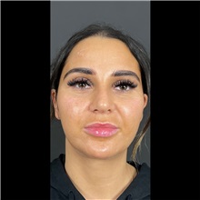 Lip Augmentation/Enhancement Before Photo by Cem Berkay SINACI, MD; Istanbul, M - Case 51067