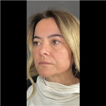 Eyelid Surgery After Photo by Cem Berkay SINACI, MD; Istanbul, M - Case 51073