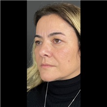 Eyelid Surgery Before Photo by Cem Berkay SINACI, MD; Istanbul, M - Case 51073