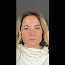 Eyelid Surgery After Photo by Cem Berkay SINACI, MD; Istanbul, M - Case 51073