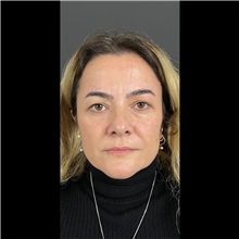 Eyelid Surgery Before Photo by Cem Berkay SINACI, MD; Istanbul, M - Case 51073