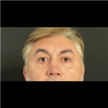 Eyelid Surgery After Photo by Cem Berkay SINACI, MD; Istanbul, M - Case 51074
