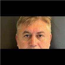 Eyelid Surgery Before Photo by Cem Berkay SINACI, MD; Istanbul, M - Case 51074