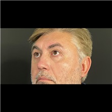 Eyelid Surgery After Photo by Cem Berkay SINACI, MD; Istanbul, M - Case 51074