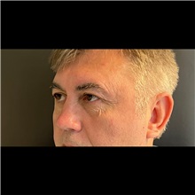 Eyelid Surgery Before Photo by Cem Berkay SINACI, MD; Istanbul, M - Case 51074