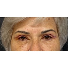 Eyelid Surgery After Photo by Cem Berkay SINACI, MD; Istanbul, M - Case 51077