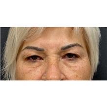 Eyelid Surgery Before Photo by Cem Berkay SINACI, MD; Istanbul, M - Case 51077