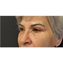 Eyelid Surgery After Photo by Cem Berkay SINACI, MD; Istanbul, M - Case 51077
