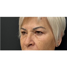Eyelid Surgery Before Photo by Cem Berkay SINACI, MD; Istanbul, M - Case 51077