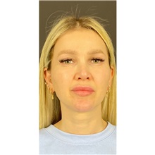 Eyelid Surgery After Photo by Cem Berkay SINACI, MD; Istanbul, M - Case 51075