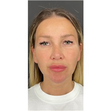 Eyelid Surgery Before Photo by Cem Berkay SINACI, MD; Istanbul, M - Case 51075