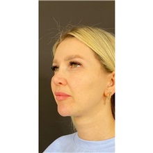 Eyelid Surgery After Photo by Cem Berkay SINACI, MD; Istanbul, M - Case 51075