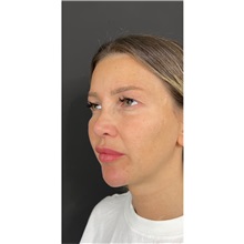 Eyelid Surgery Before Photo by Cem Berkay SINACI, MD; Istanbul, M - Case 51075