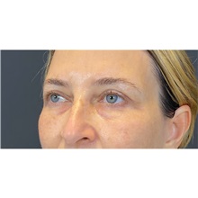 Eyelid Surgery After Photo by Cem Berkay SINACI, MD; Istanbul, M - Case 51076
