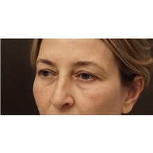 Eyelid Surgery Before Photo by Cem Berkay SINACI, MD; Istanbul, M - Case 51076