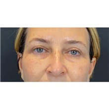 Eyelid Surgery After Photo by Cem Berkay SINACI, MD; Istanbul, M - Case 51076