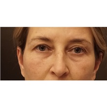 Eyelid Surgery Before Photo by Cem Berkay SINACI, MD; Istanbul, M - Case 51076